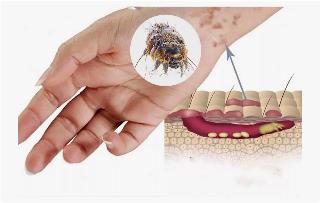 Роспотребнадзор информирует. Чесотка - заразная болезнь, возбудителем которой является чесоточный клещ